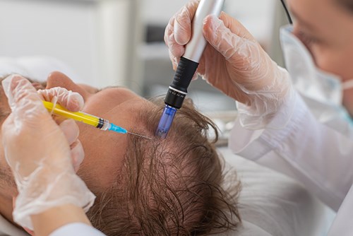 Exosome Hair Restoration